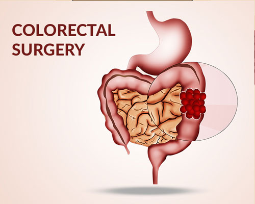 Colorectal-Surgery